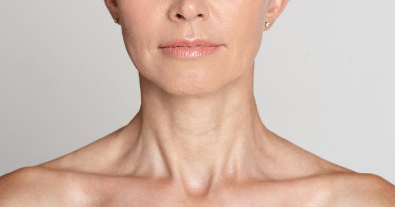 Woman with visible vertical platysmal bands in the neck.