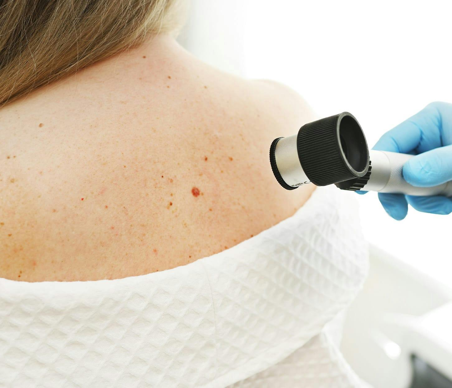 woman's back with moles and skin tags being inspected