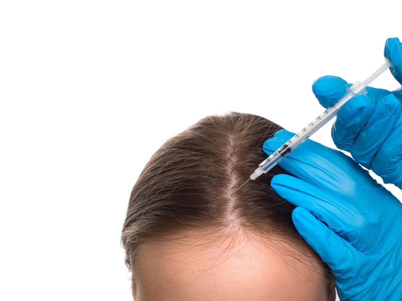 Woman receiving PRF injection in her scalp