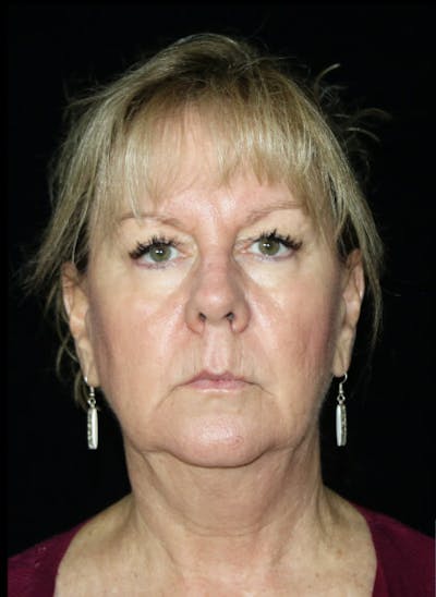 Facelift Before & After Gallery - Patient 324984 - Image 1