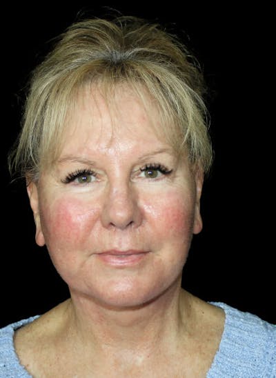 Facelift Before & After Gallery - Patient 324984 - Image 2