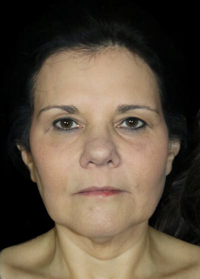 Facelift Before & After Gallery - Patient 145410 - Image 1