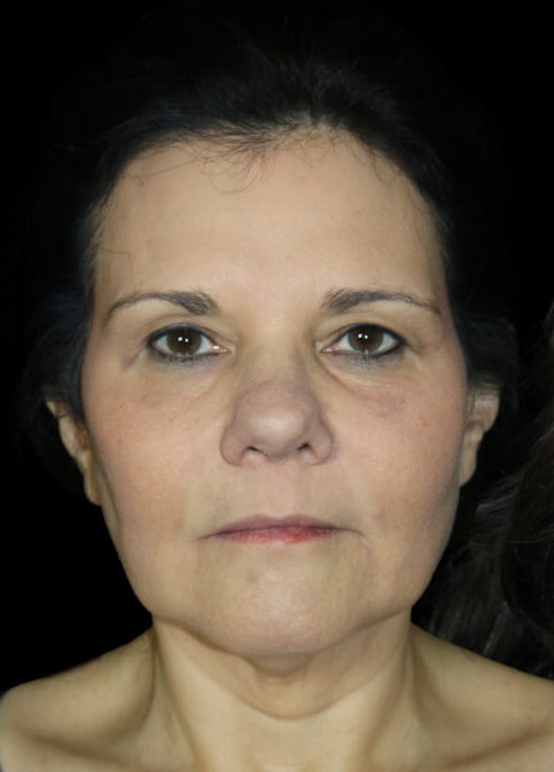 Facelift Before & After Gallery - Patient 145410 - Image 1