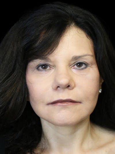 Facelift Before & After Gallery - Patient 145410 - Image 2