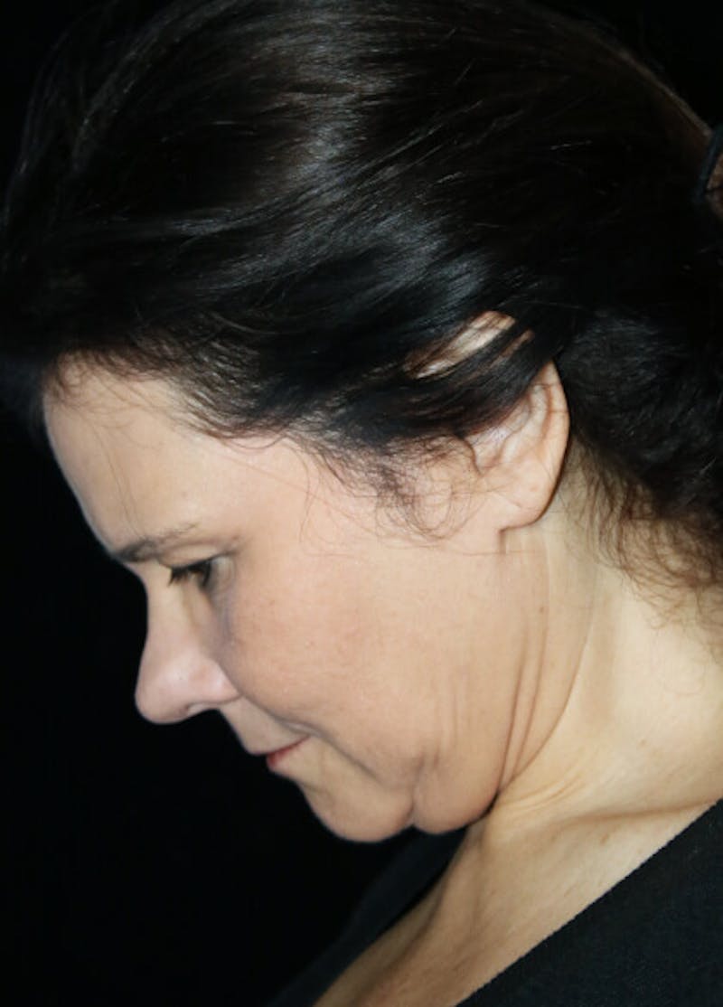 Facelift Before & After Gallery - Patient 145410 - Image 3
