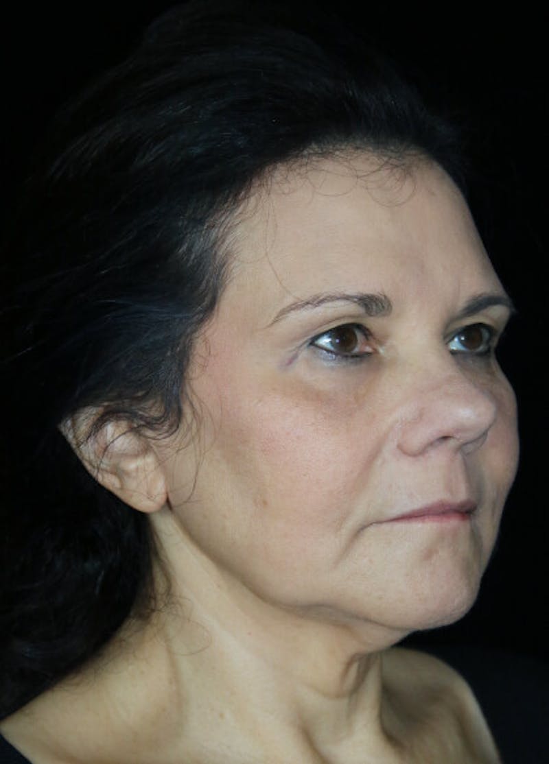 Facelift Before & After Gallery - Patient 145410 - Image 5