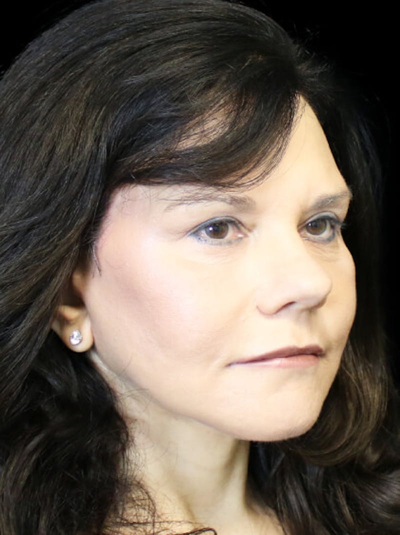 Facelift Before & After Gallery - Patient 145410 - Image 6