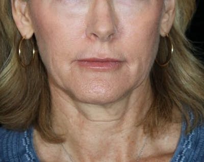 Facelift Before & After Gallery - Patient 380961 - Image 1