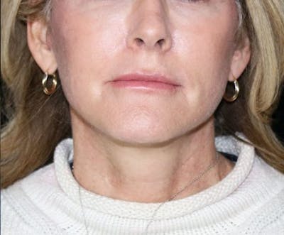Facelift Before & After Gallery - Patient 380961 - Image 2