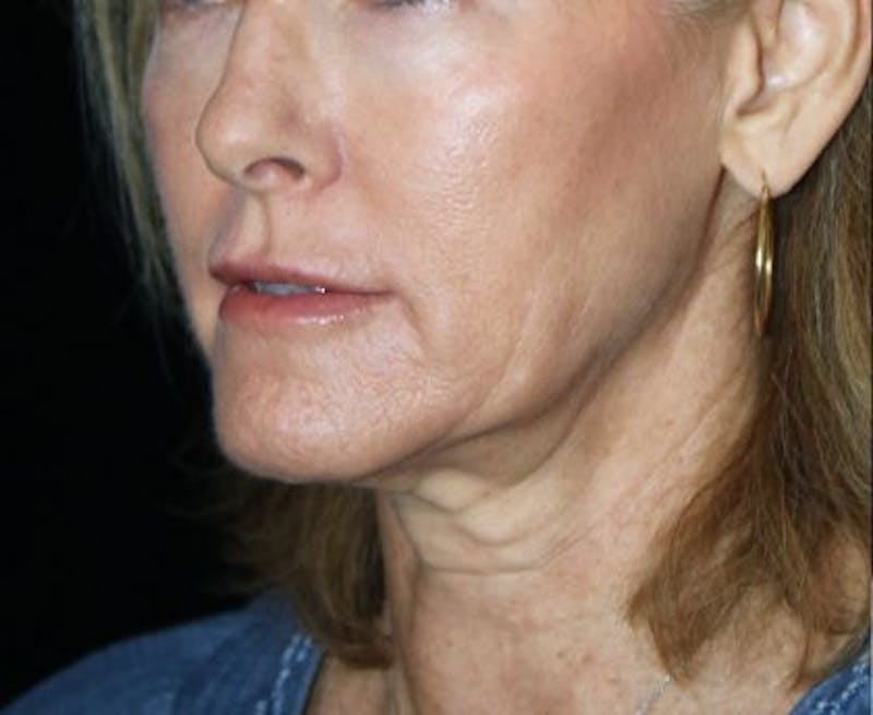 Facelift Before & After Gallery - Patient 380961 - Image 3