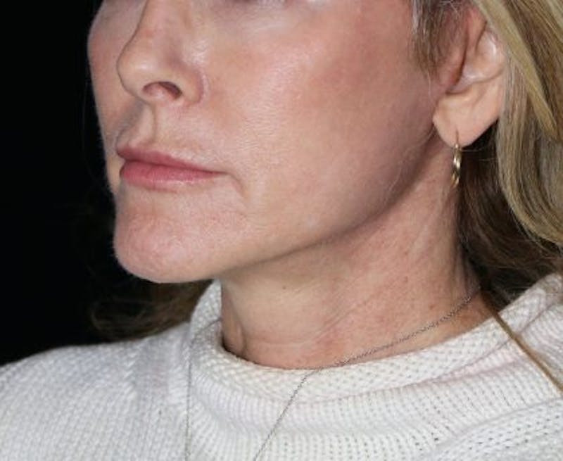Facelift Before & After Gallery - Patient 380961 - Image 4