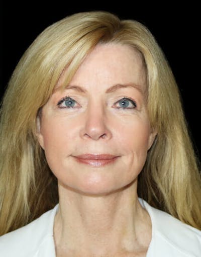 Facelift Before & After Gallery - Patient 126089 - Image 2