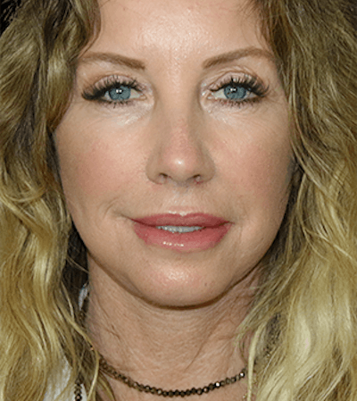 Facelift Before & After Gallery - Patient 338016 - Image 2