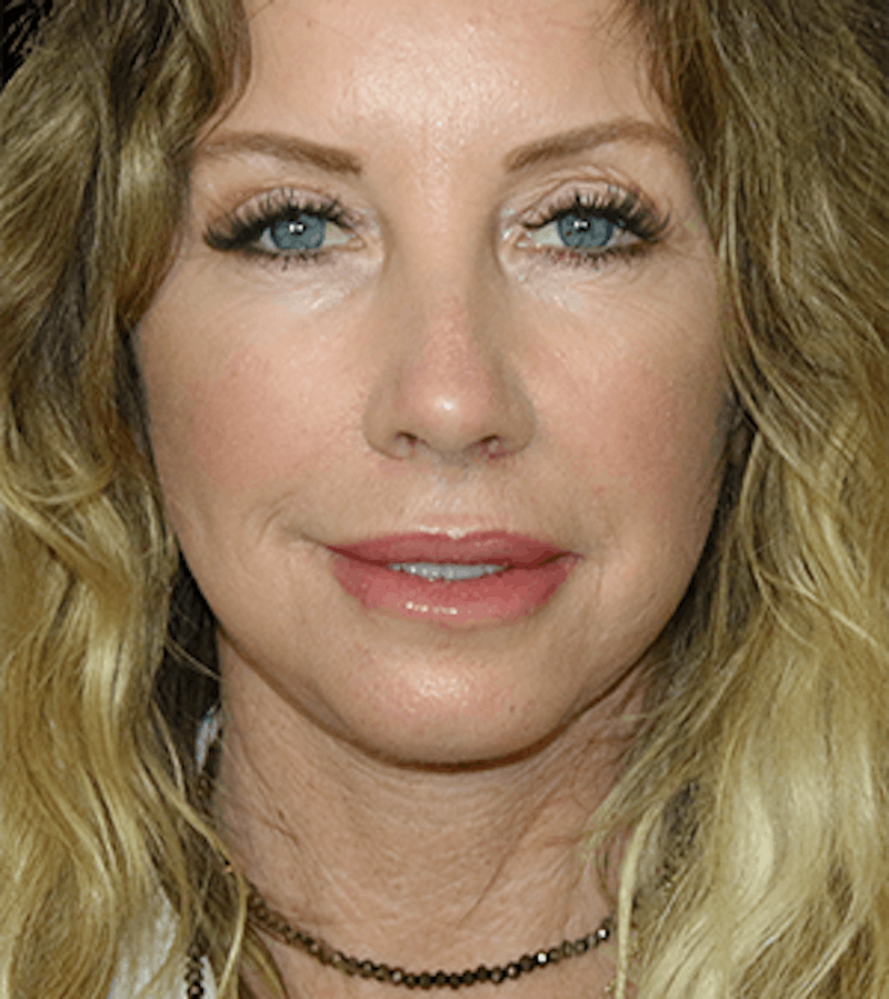 Facelift Before & After Gallery - Patient 338016 - Image 2