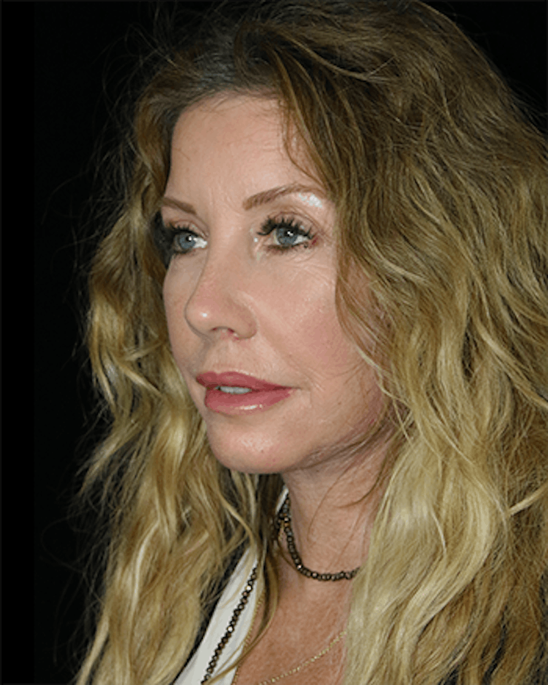 Facelift Before & After Gallery - Patient 338016 - Image 4