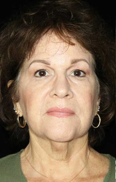 Facelift Before & After Gallery - Patient 244906 - Image 1