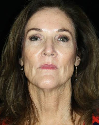 Facelift Before & After Gallery - Patient 365654 - Image 1