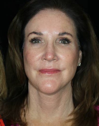 Facelift Before & After Gallery - Patient 365654 - Image 2