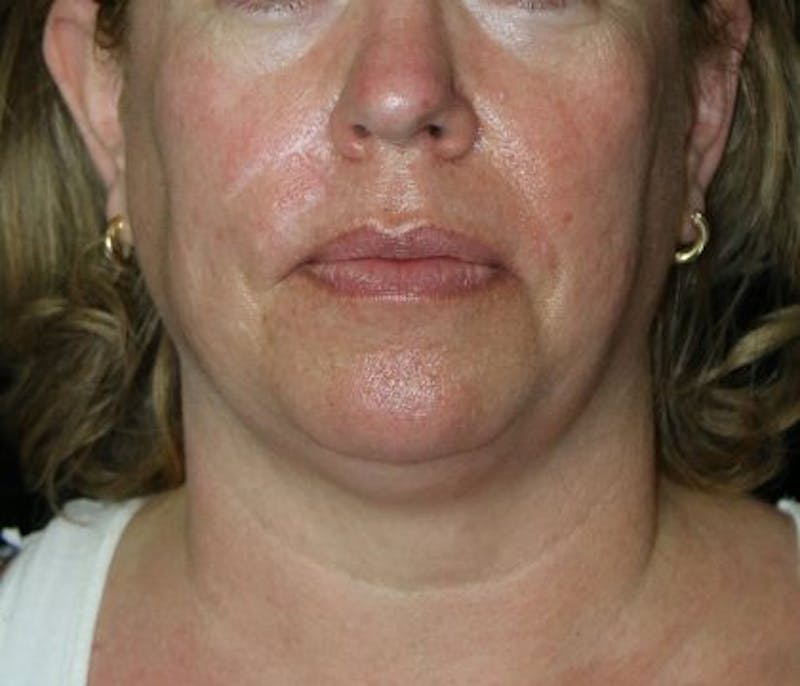 Facelift Before & After Gallery - Patient 335498 - Image 1
