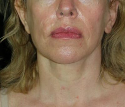 Facelift Before & After Gallery - Patient 335498 - Image 2
