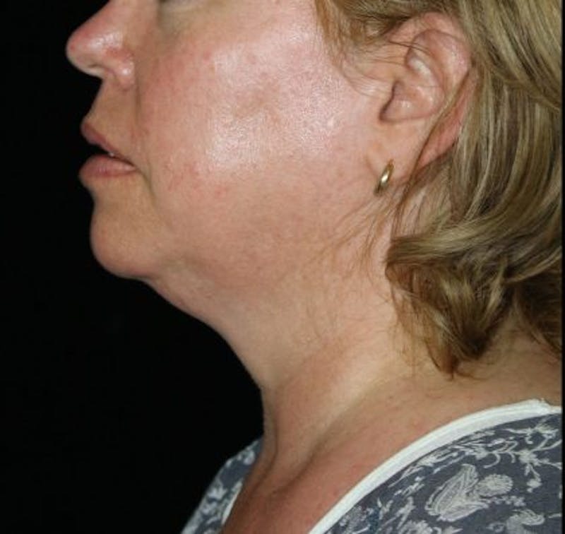 Facelift Before & After Gallery - Patient 335498 - Image 3