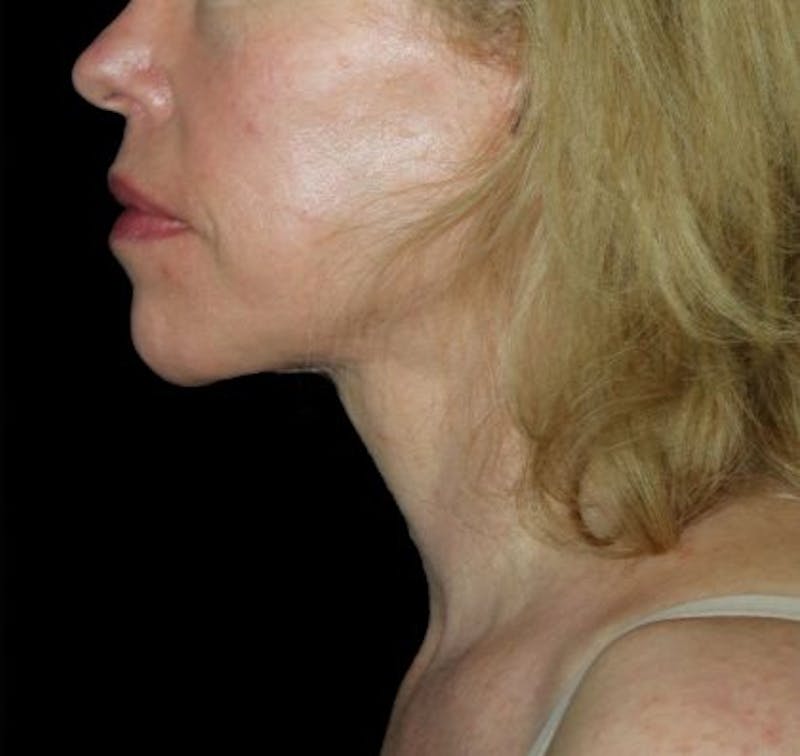Facelift Before & After Gallery - Patient 335498 - Image 4