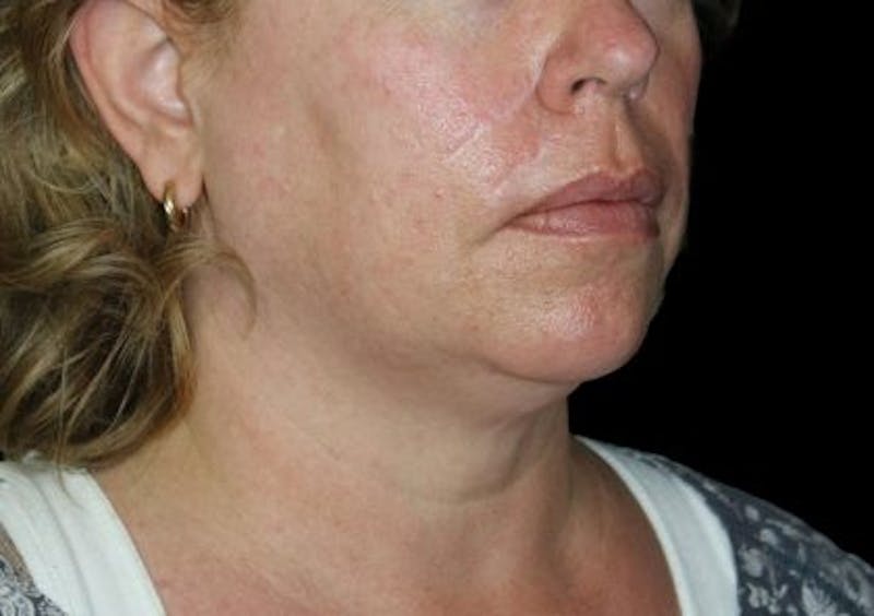 Facelift Before & After Gallery - Patient 335498 - Image 5