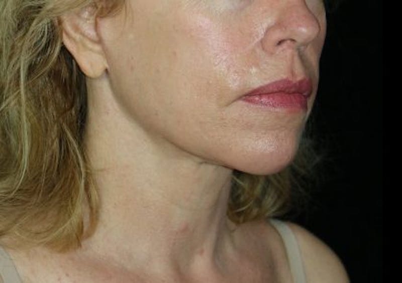 Facelift Before & After Gallery - Patient 335498 - Image 6