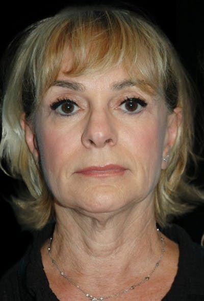 Facelift Before & After Gallery - Patient 769122 - Image 1