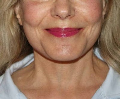 Facelift Before & After Gallery - Patient 305764 - Image 2