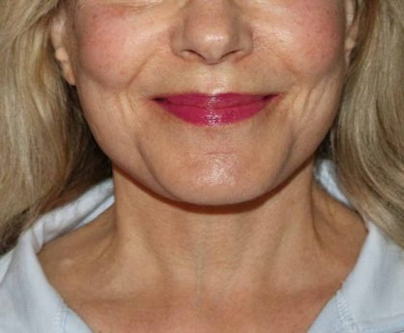 Facelift Before & After Gallery - Patient 305764 - Image 2