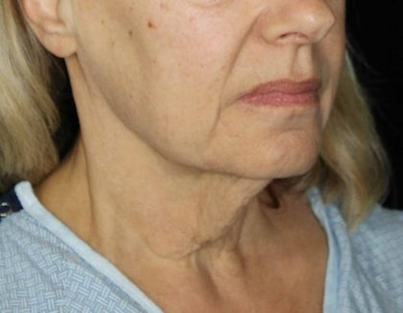 Facelift Before & After Gallery - Patient 305764 - Image 3
