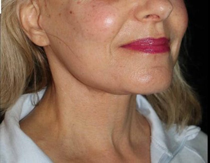 Facelift Before & After Gallery - Patient 305764 - Image 4