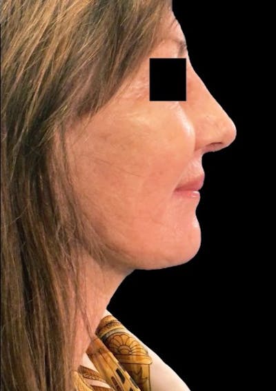 Facelift Before & After Gallery - Patient 201441 - Image 2