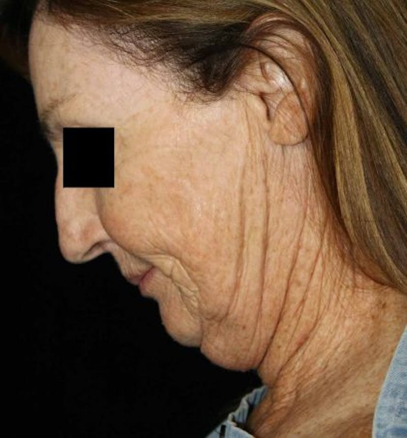 Facelift Before & After Gallery - Patient 201441 - Image 3