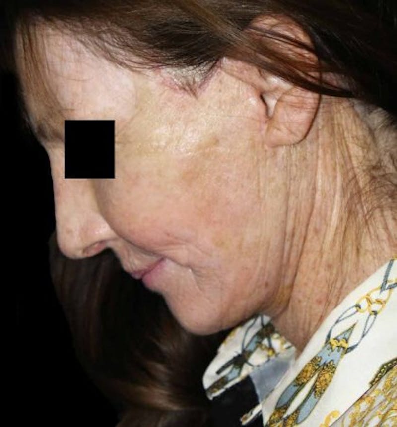 Facelift Before & After Gallery - Patient 201441 - Image 4