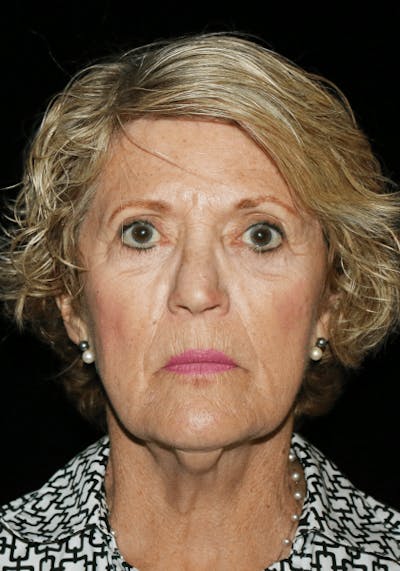 Facelift Before & After Gallery - Patient 268892 - Image 1