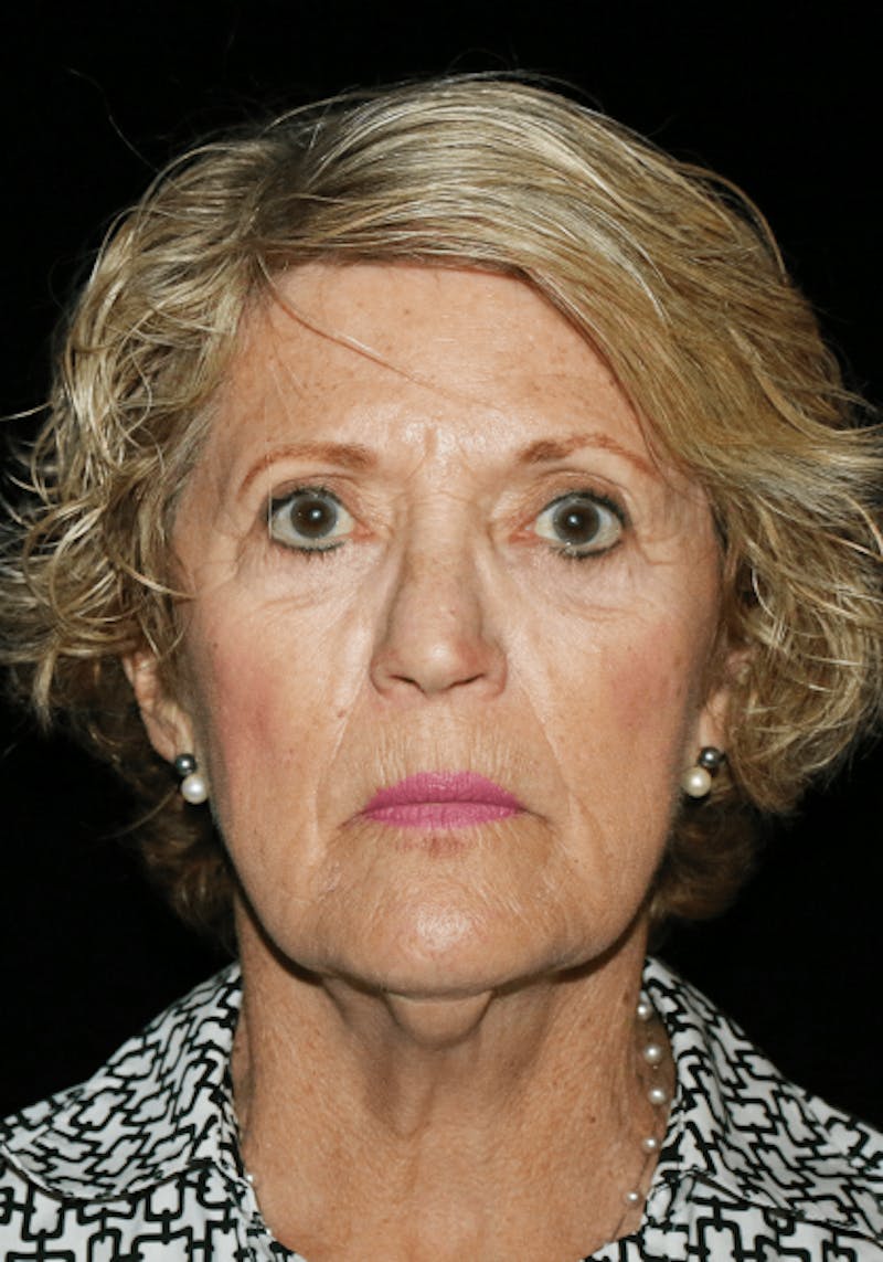 Facelift Before & After Gallery - Patient 268892 - Image 1