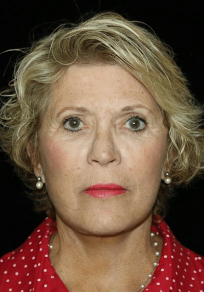 Facelift Before & After Gallery - Patient 268892 - Image 2