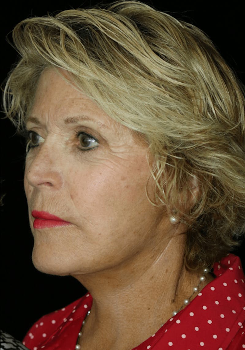 Facelift Before & After Gallery - Patient 268892 - Image 4