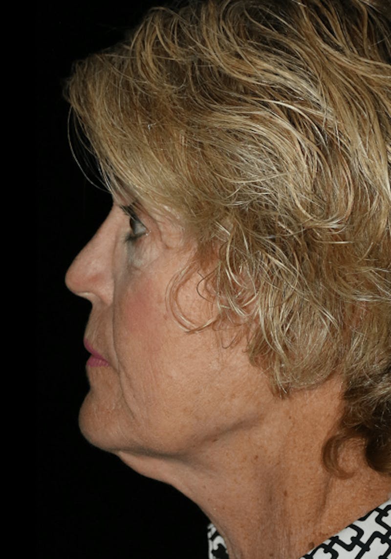 Facelift Before & After Gallery - Patient 268892 - Image 5