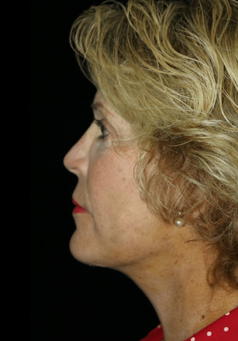 Facelift Before & After Gallery - Patient 268892 - Image 6