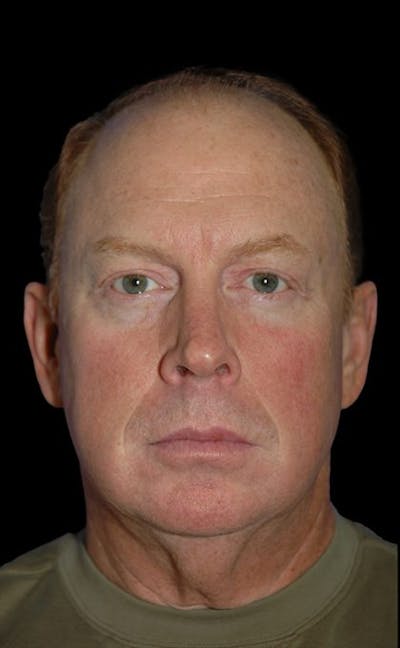 Facelift Before & After Gallery - Patient 257119 - Image 1
