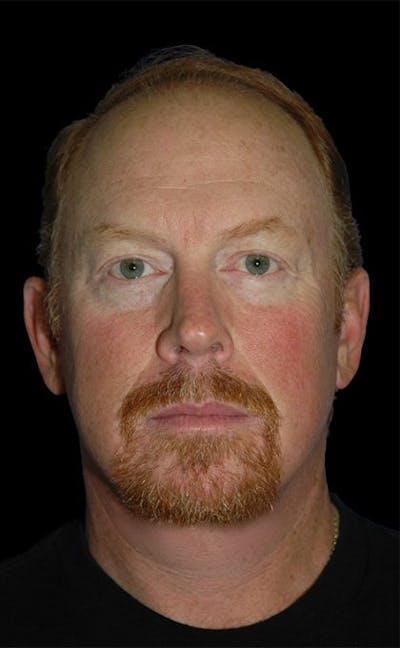 Facelift Before & After Gallery - Patient 257119 - Image 2