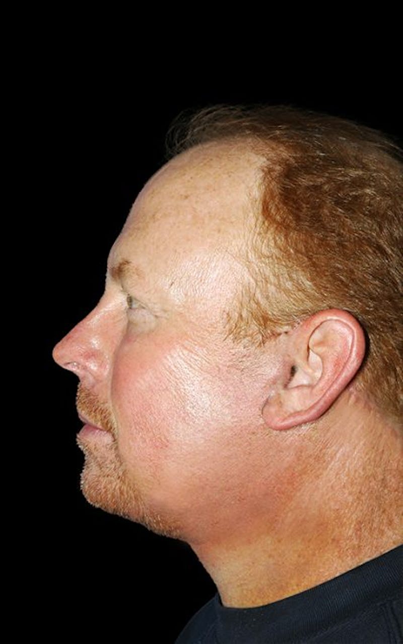 Facelift Before & After Gallery - Patient 257119 - Image 4