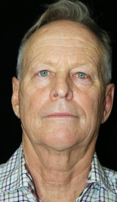 Facelift Before & After Gallery - Patient 341459 - Image 1