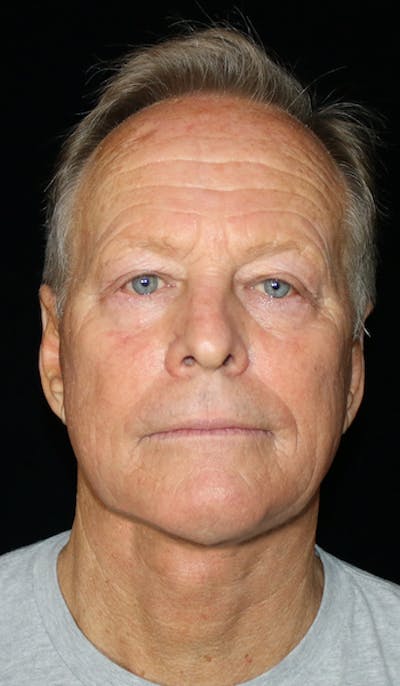 Facelift Before & After Gallery - Patient 341459 - Image 2