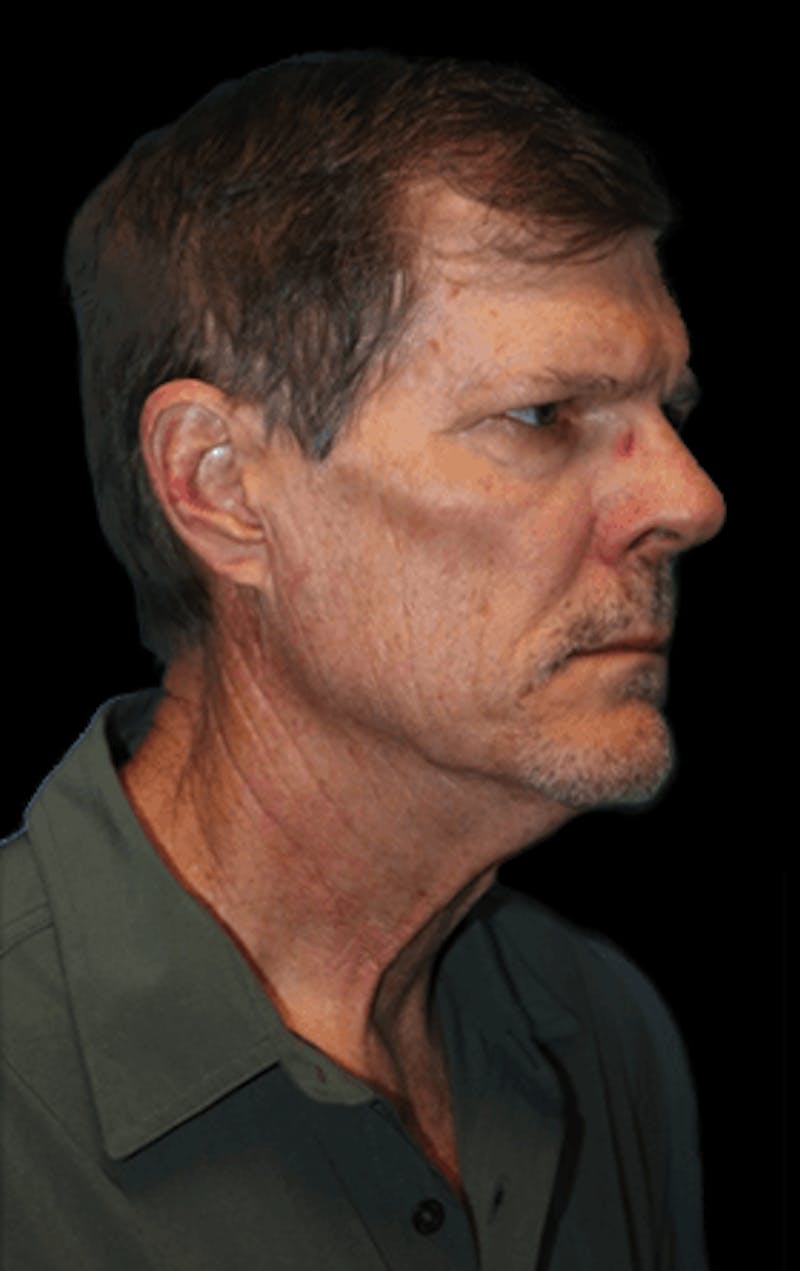 Facelift Before & After Gallery - Patient 277897 - Image 1