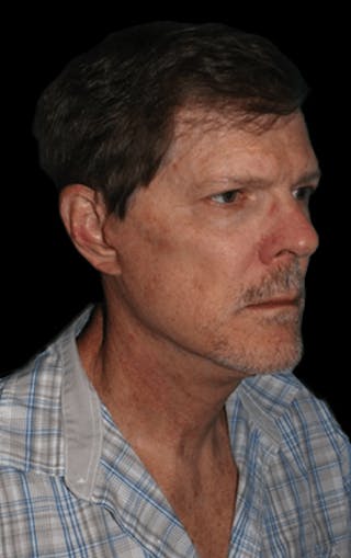 Facelift Before & After Gallery - Patient 277897 - Image 2
