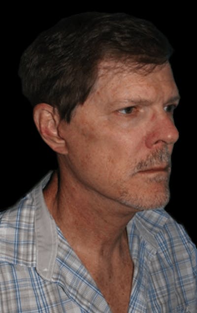 Facelift Before & After Gallery - Patient 277897 - Image 2